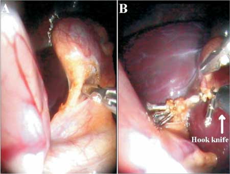 laparoscopic gallbladder removal. gallbladder removal