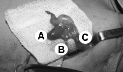 Aspecto do testculo no segundo tempo, A=local da ligadura dos vasos; B=deferente; C=gubernculo