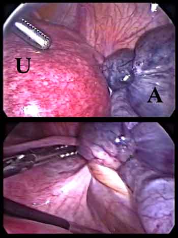 Ooforectomia videoassistida por acesso pré-femural em targaruga-de